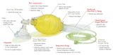 Laerdal The Bag II® Disposable Resuscitator BVM (Bag/Valve/Mask)